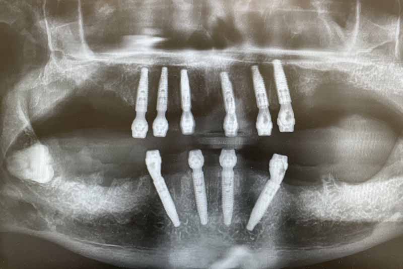 Impianto denti fissi in titanio - dentista a Brescia
