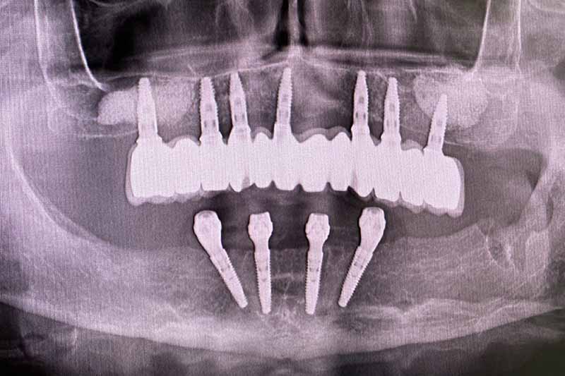 Impianto denti fissi in titanio - dentista a Brescia
