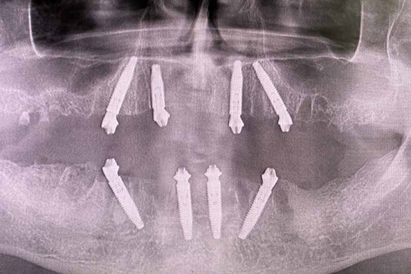 Impianto denti fissi in titanio - dentista a Brescia