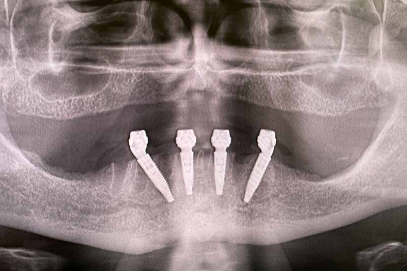Impianto denti fissi in titanio - dentista a Brescia