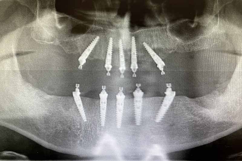 Impianto denti fissi in titanio - dentista a Brescia
