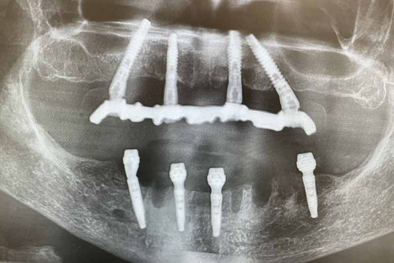 Impianto denti fissi in titanio - dentista a Brescia